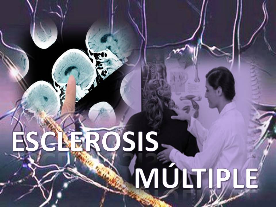 esclerosis