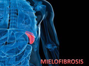 mielofibrosis