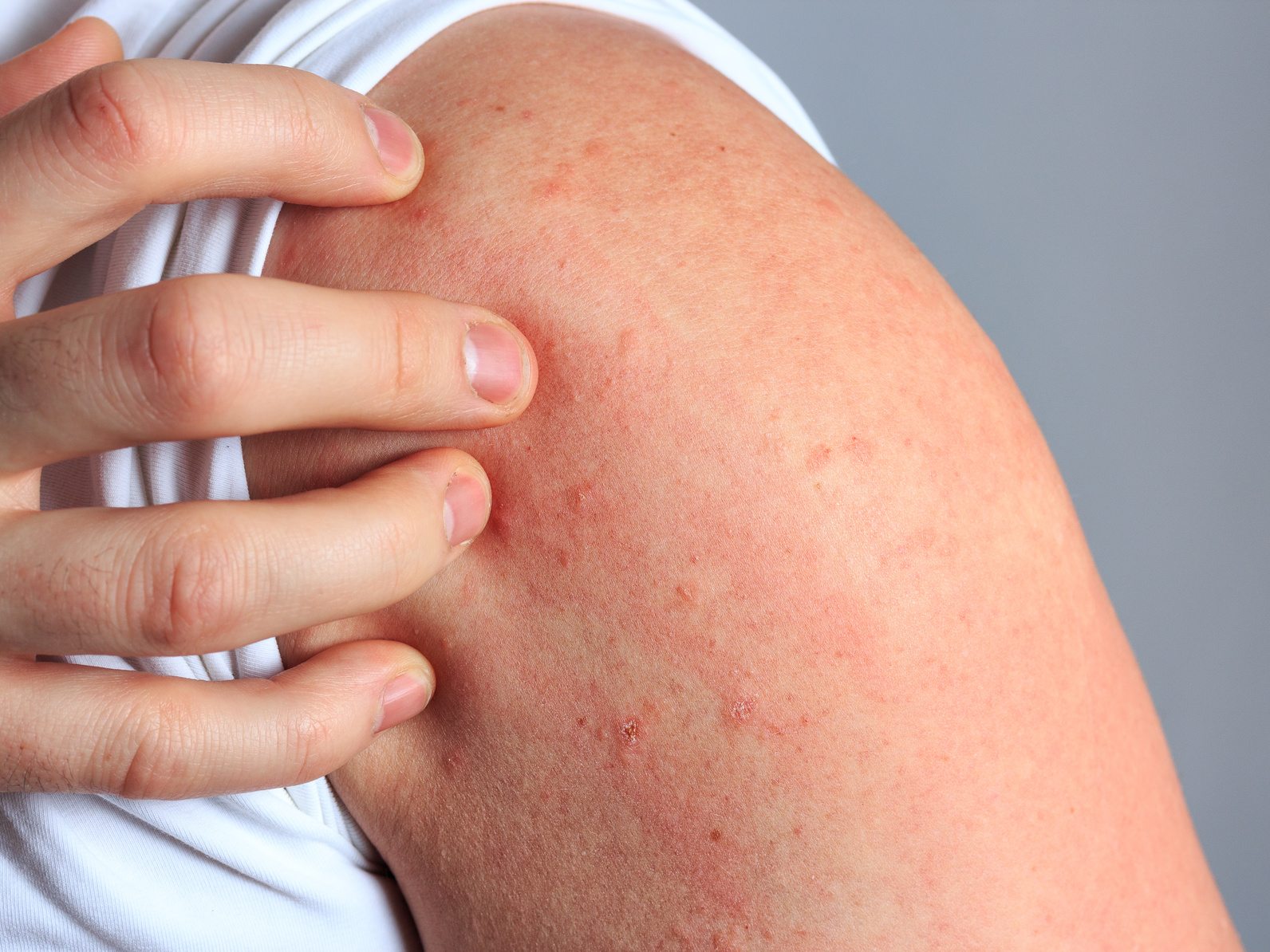 Dermatitis por contacto alérgico